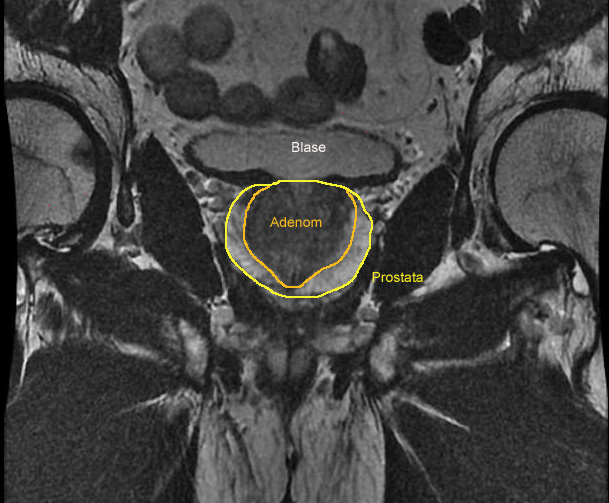 Аденома простаты мрт